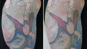 If A Tattoo Will No Longer Be Wanted, Will It Be Removed?