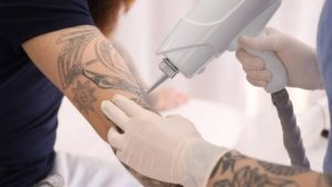 Types Of Tattoo Removal For Those Considering Tattoo Removal