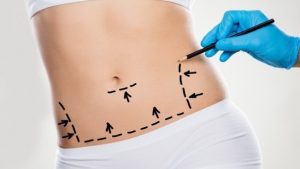 Flatten Your Tummy: Unveiling the Wonders of Abdominoplasty