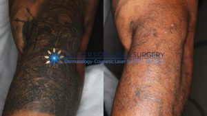 Dermasal Tattoo Removal Cream Guide