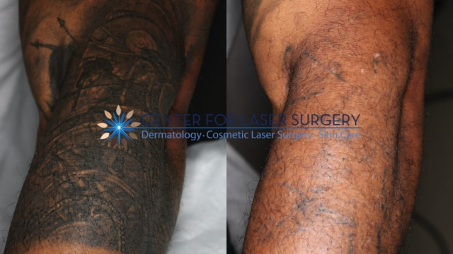 Tattoo Removal – This Is The Way To Executed The Right And Safe Way