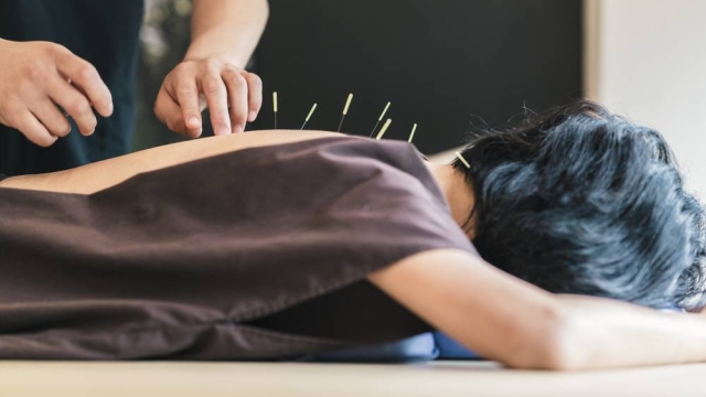 The Healing Power of Acupuncture: Needle Your Way to Wellness